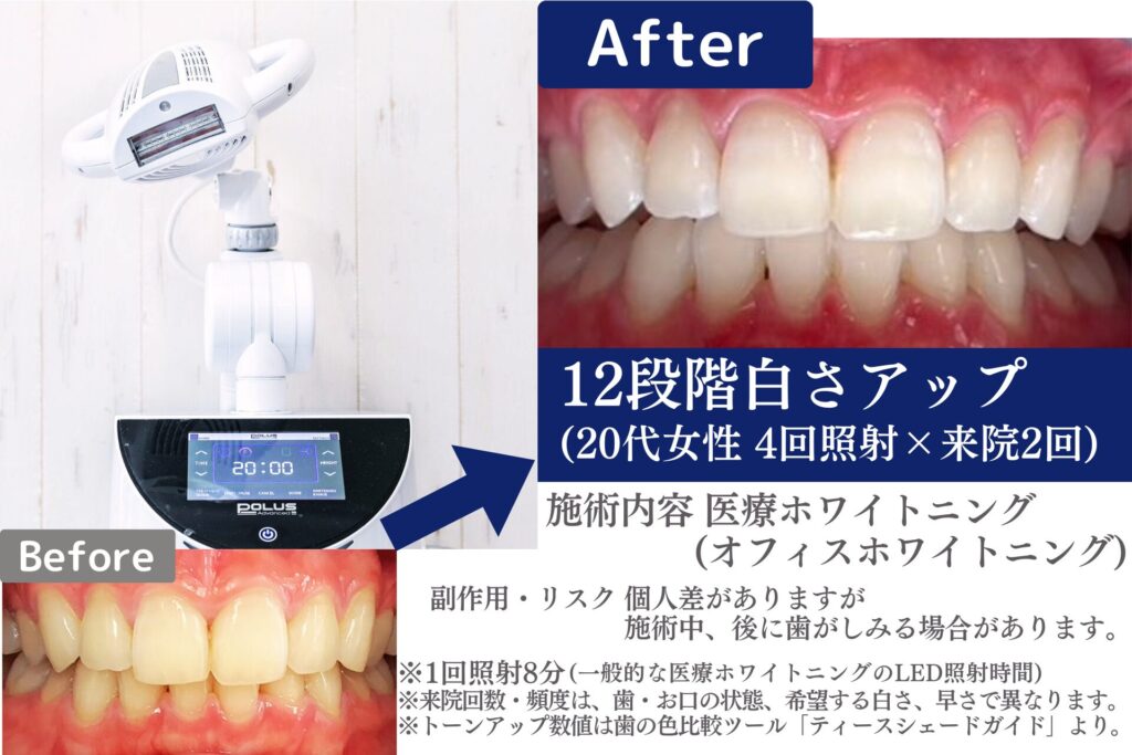 オフィスホワイトニング【都内最安値医療ホワイトニング】【さくら 