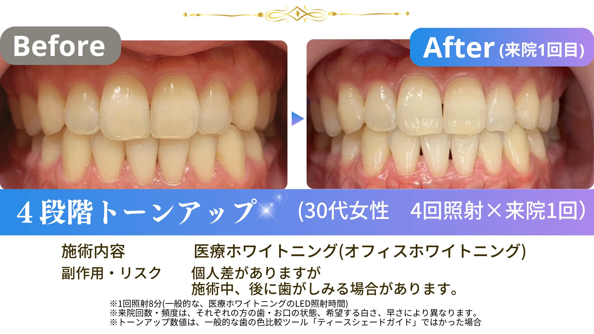 理想の白い歯へ！オフィスホワイトニングは何度で効果が出る？ | 渋谷