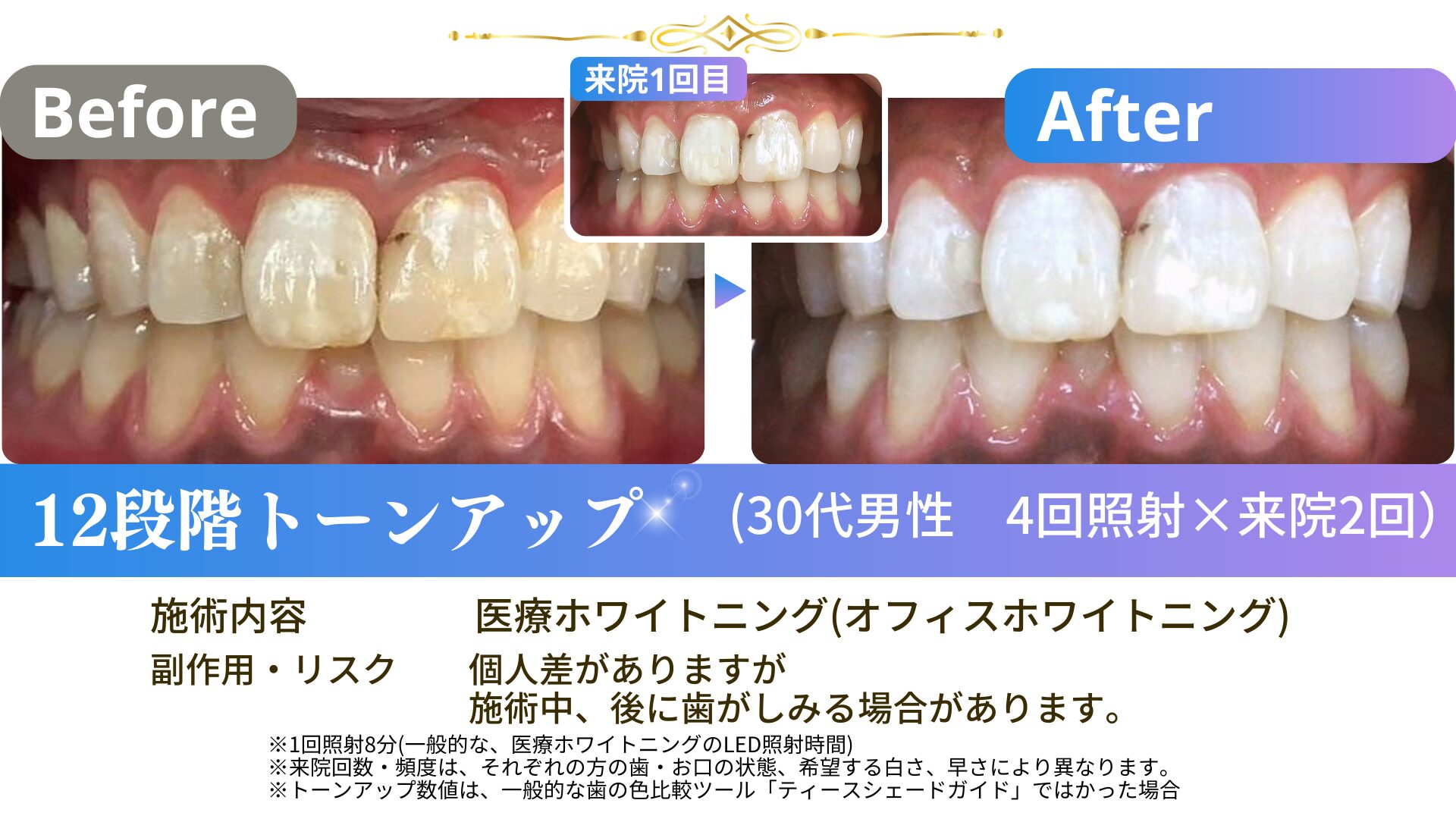 オフィスホワイトニングの回数と期間｜理想の白さになるには何回？