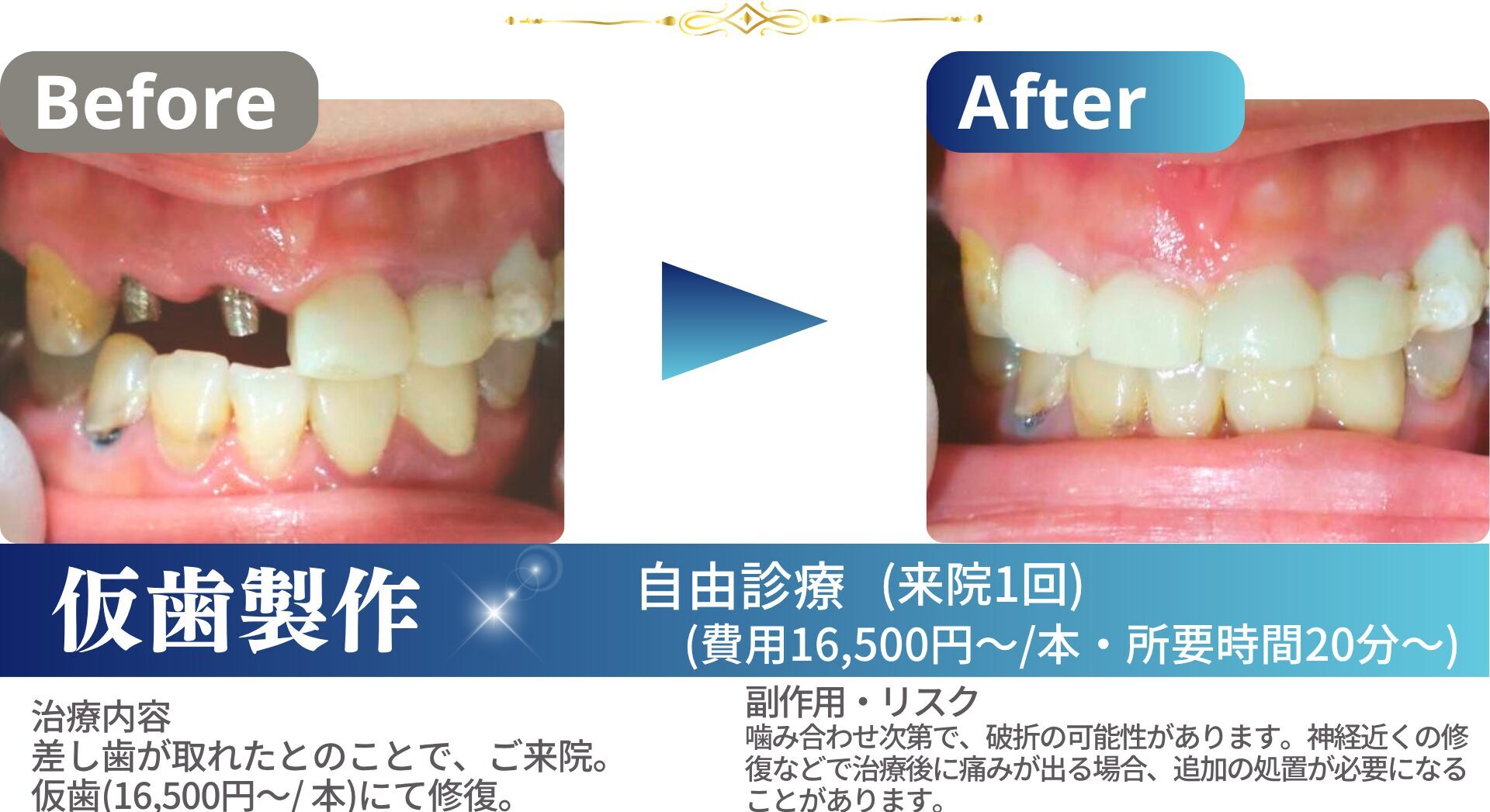241113仮歯製作1-1まとめtemp01