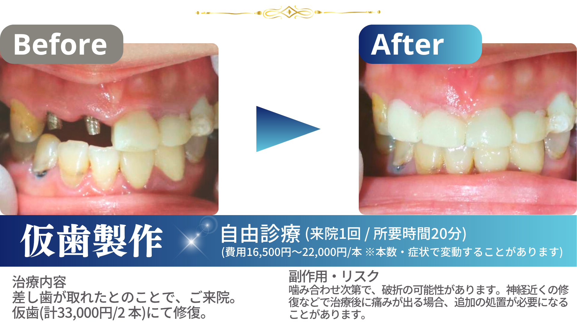 241113仮歯製作1-1まとめtemp01