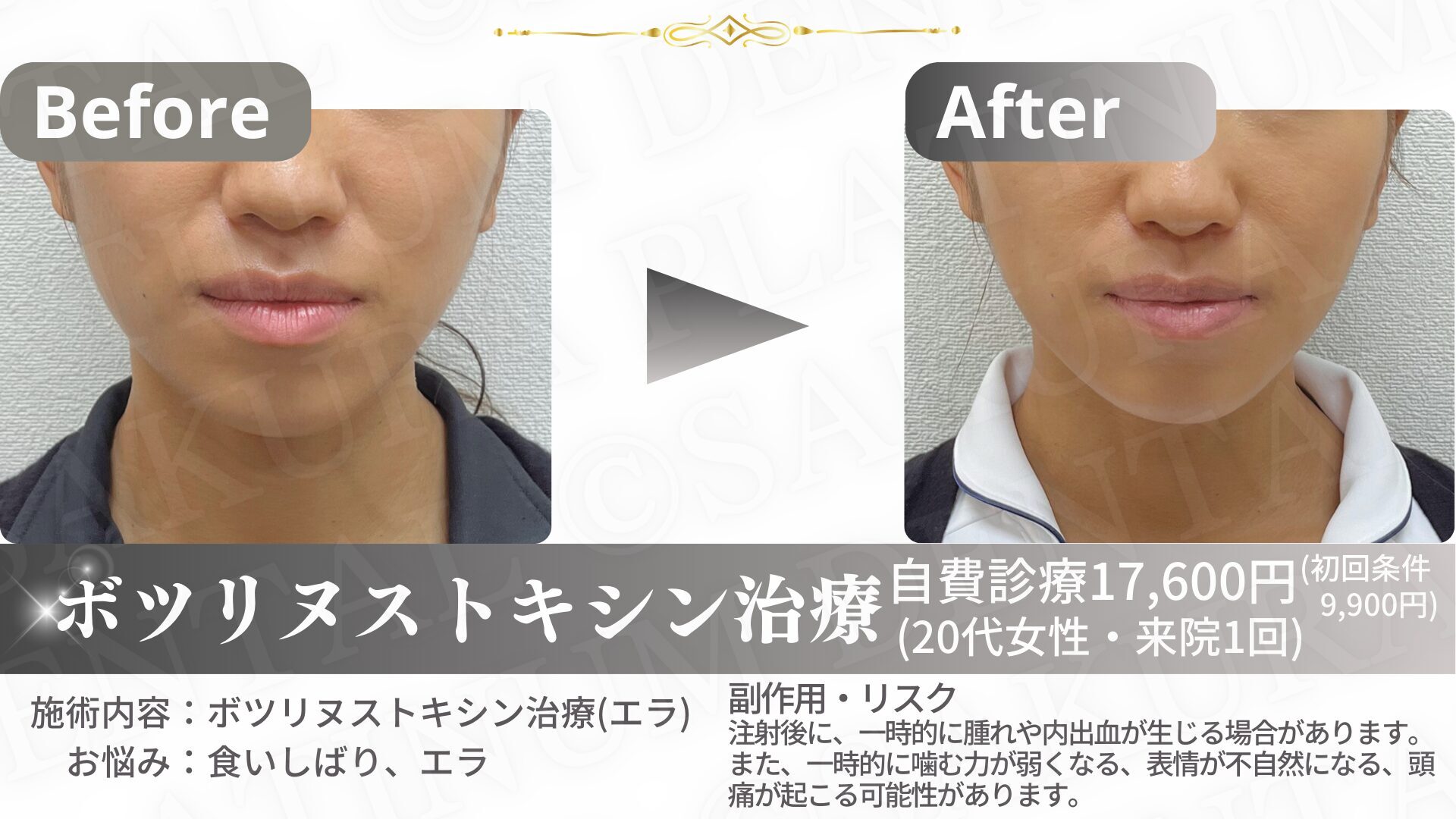 ボツリヌストキシン注射 100単位（3部位から選択）※初診料込 ボトックス注射 | 美容皮膚科・美容外科・婦人科形成 サクラアズ