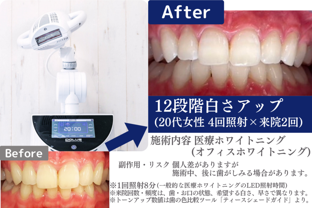 オフィスホワイトニング【都内最安値医療ホワイトニング】【さくら 