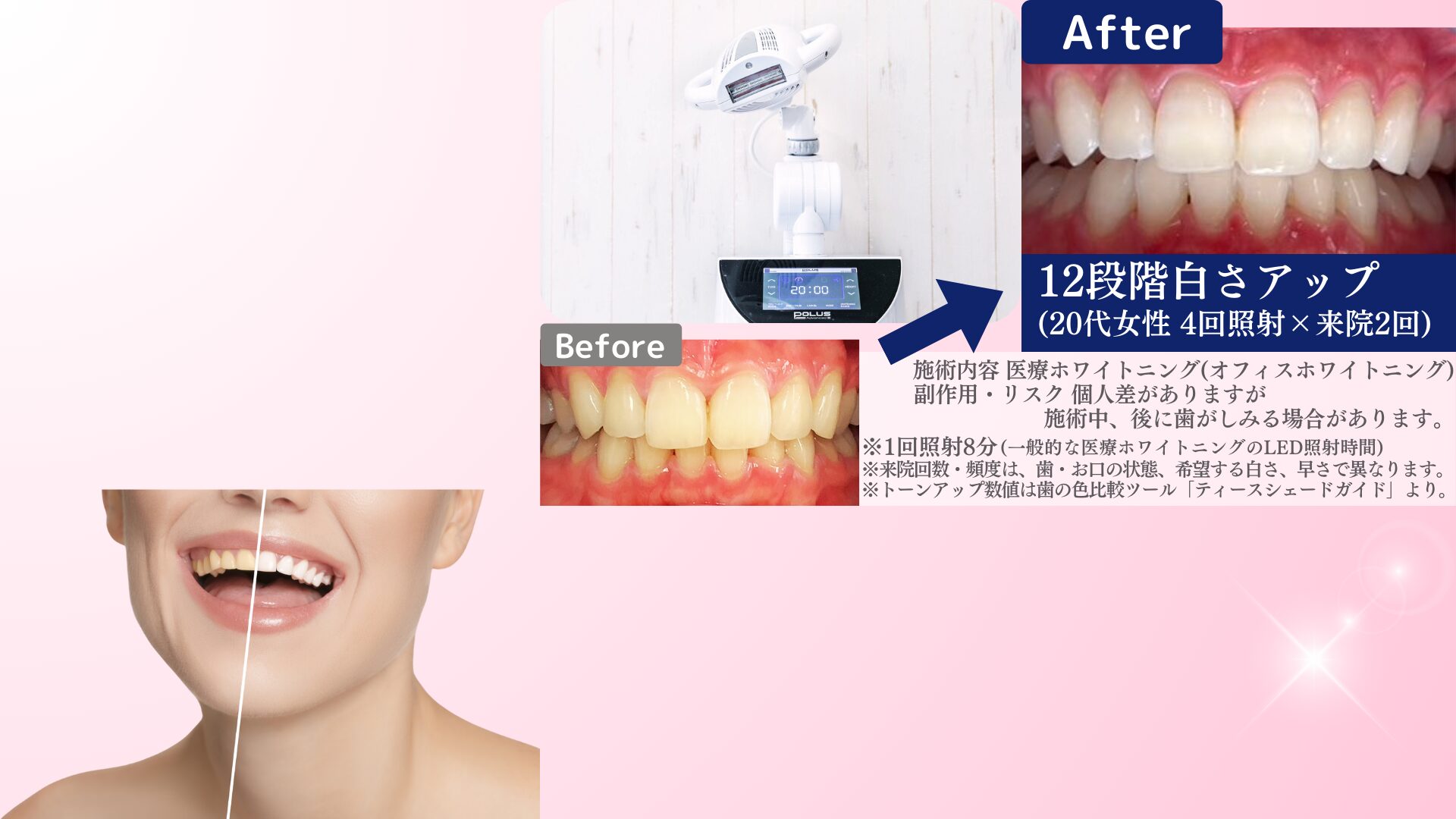 ホワイトニングで歯は傷つかない！痛みの原因と安全性を徹底解説