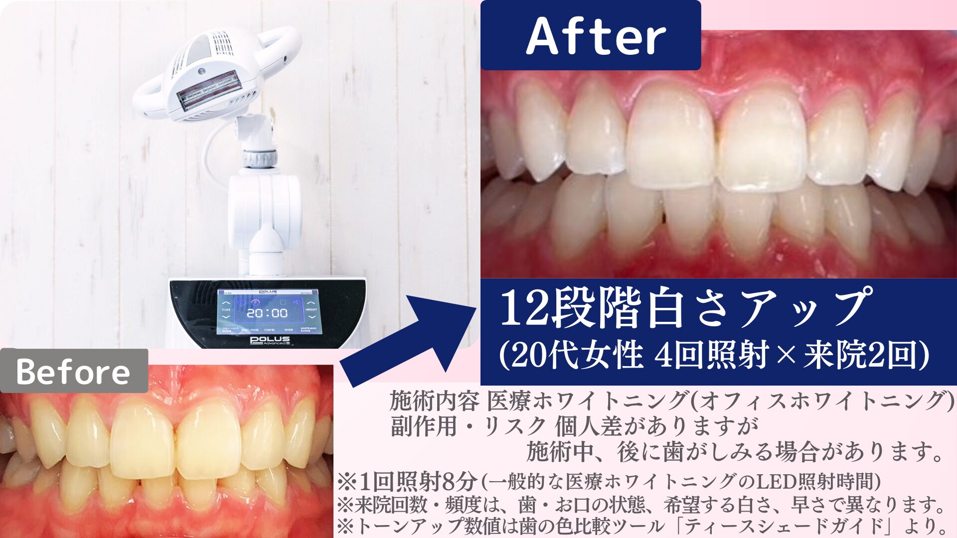 ホワイトニングだけで大丈夫？クリーニングが重要な理由と相乗効果
